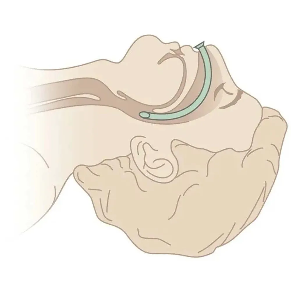 Назофарингеальный воздуховод Rhino Rescue с доставкой по России | BreadyФото 6