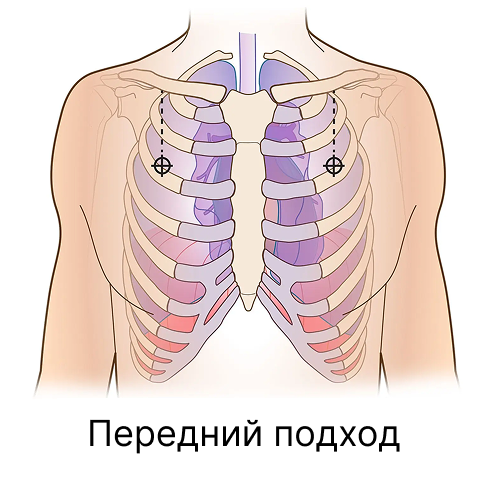 Rhino Rescue декомпрессионная игла для пневмоторакса 14ga PZQX0014 с доставкой по России | BreadyФото 7