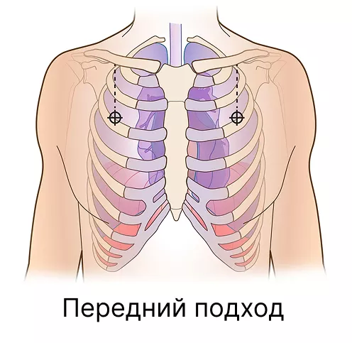 Rhino Rescue декомпрессионная игла для пневмоторакса 10ga PZQX0016 с доставкой по России | BreadyФото 8