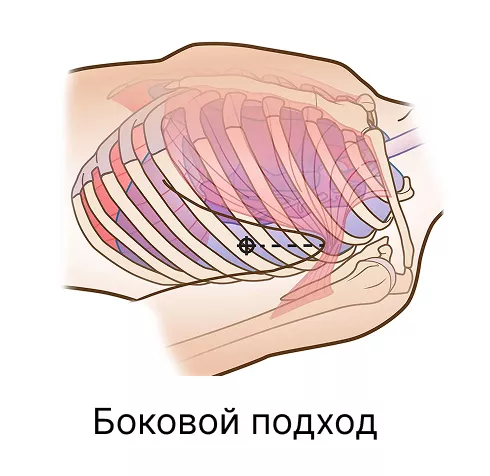 Rhino Rescue декомпрессионная игла для пневмоторакса 10ga PZQX0016 с доставкой по России | BreadyФото 7