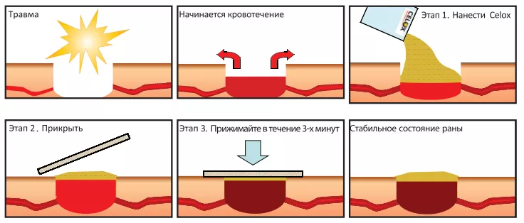 celox-2.jpg